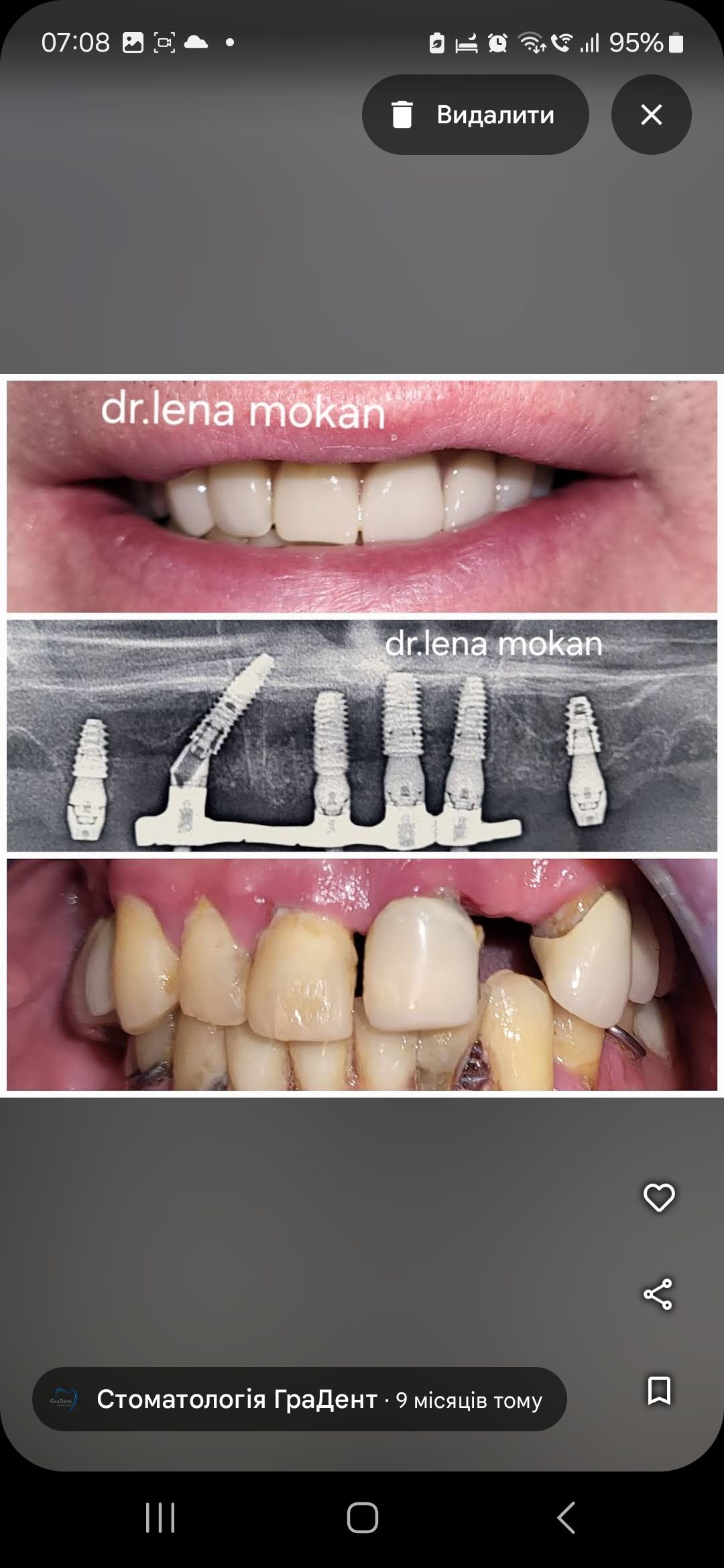 Концепція все на чотирьох Імплантологія